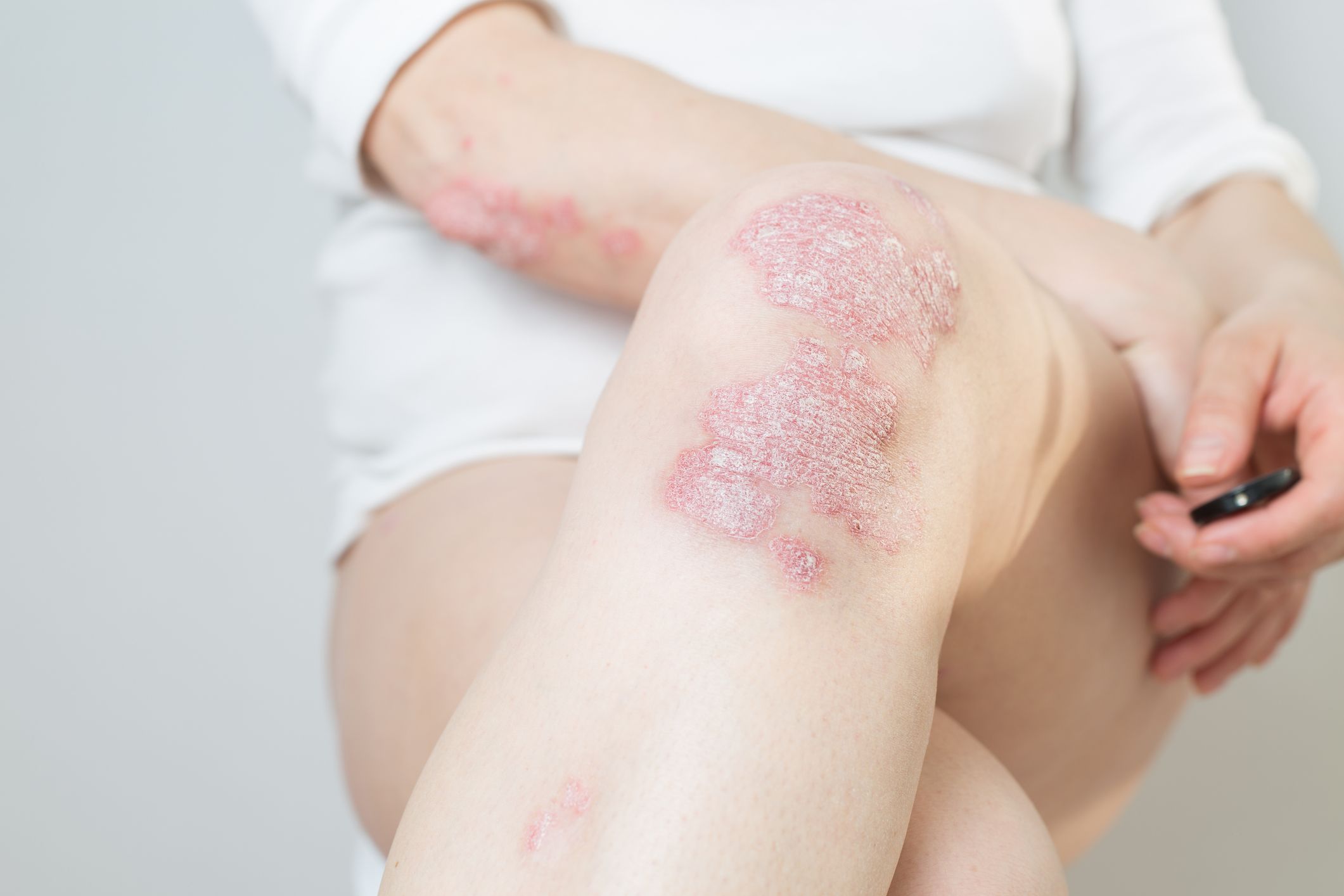 Finding a Psoriasis Treatment that Works