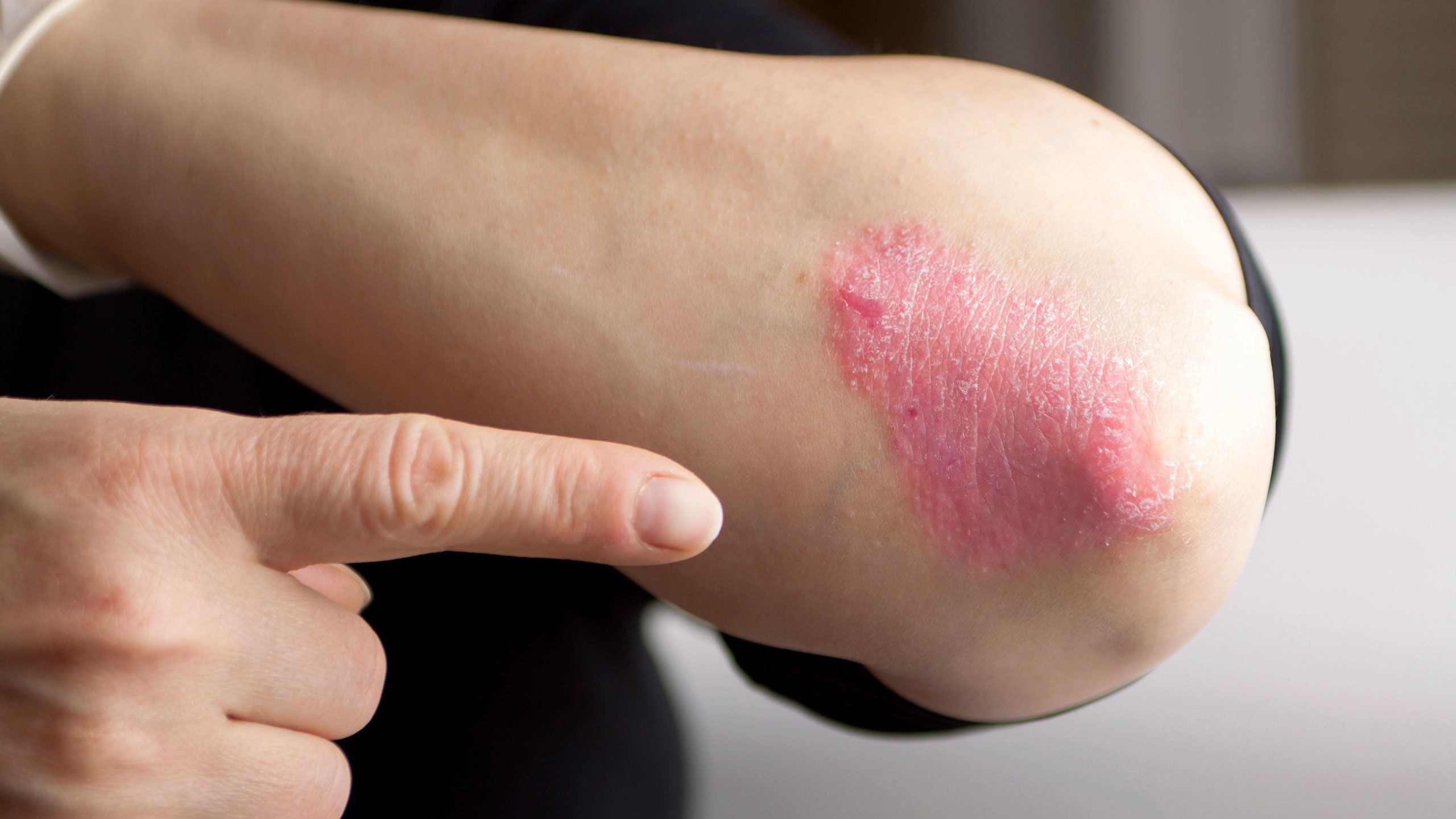 Taking Charge of Moderate-to-Severe Psoriasis