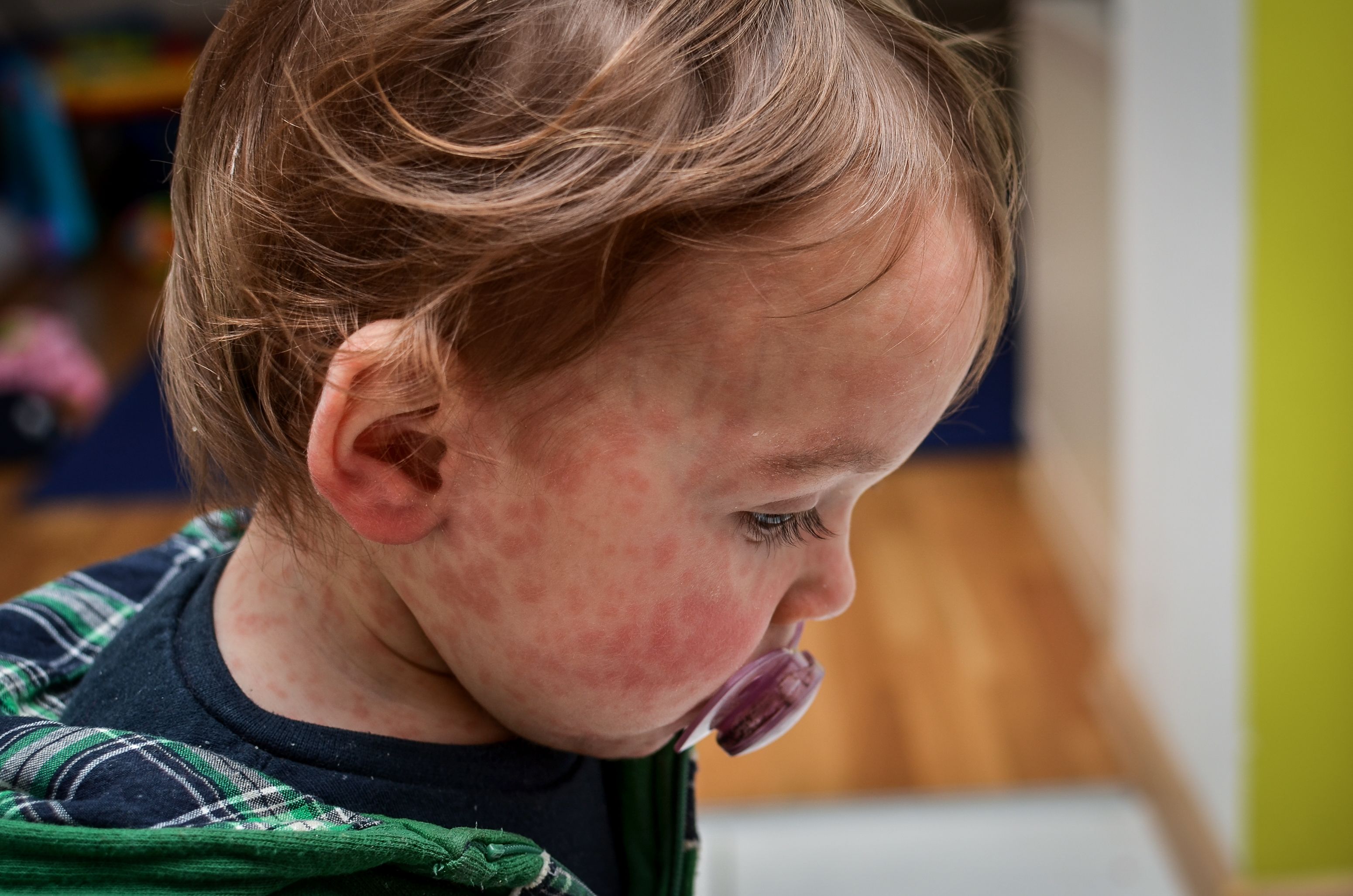 5 important facts about measles