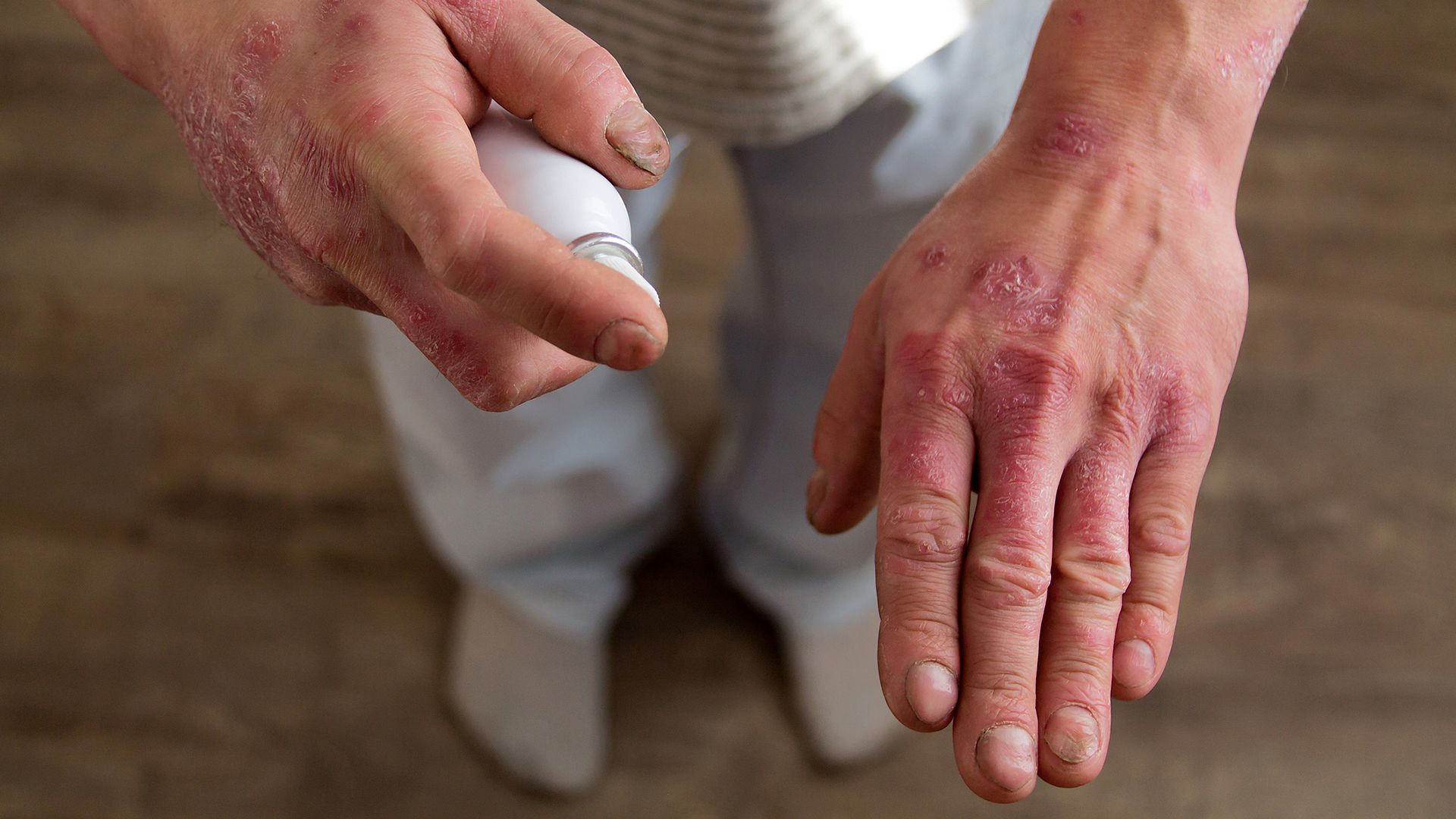 mild psoriasis hands