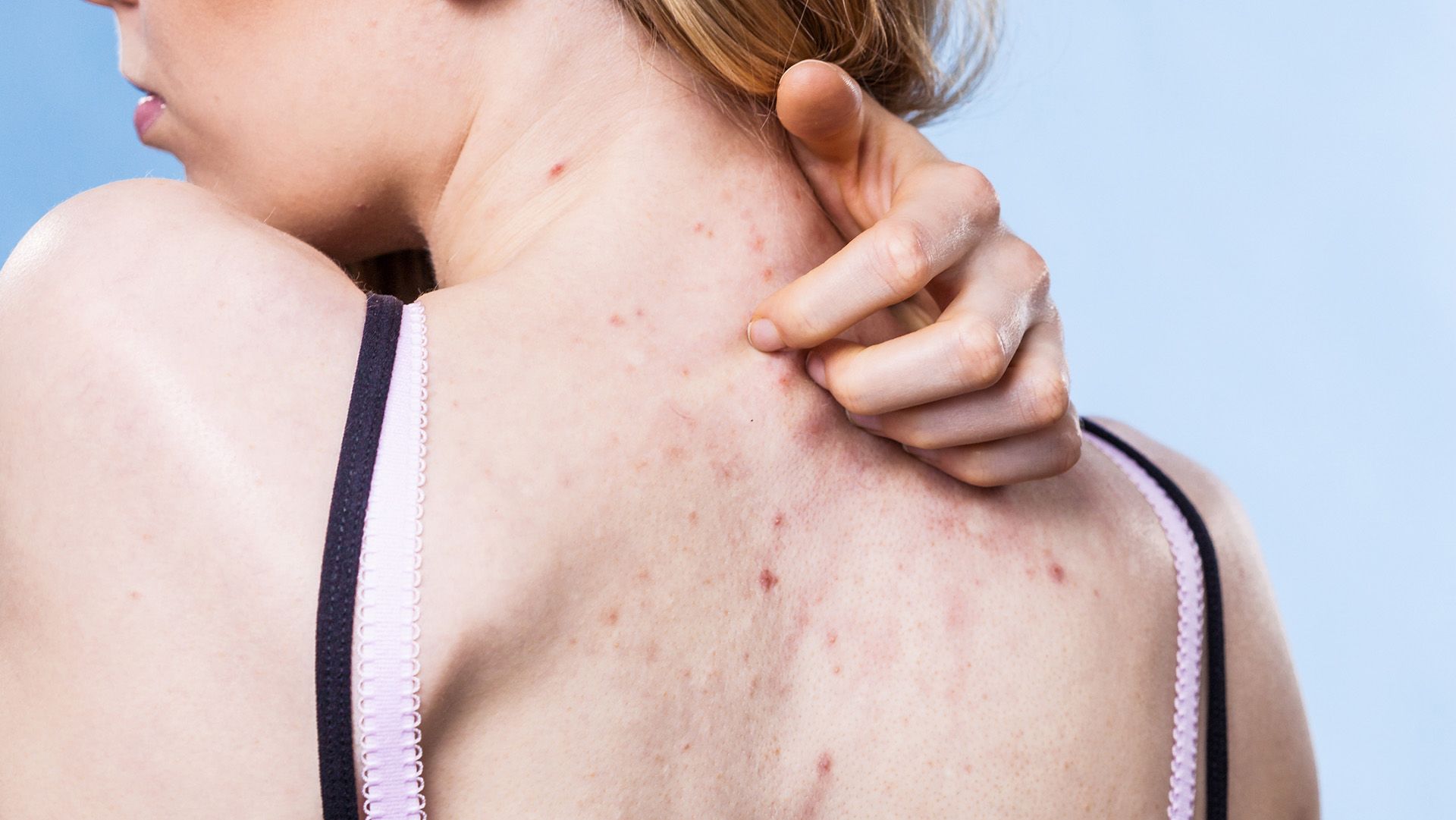 Hidradenitis Suppurativa: Symptoms, Severity, and Stages