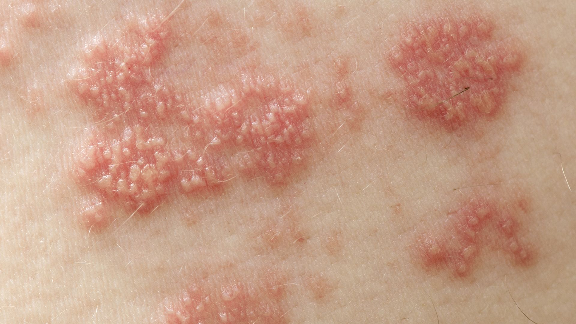 How Long Can a Shingles Rash Last?