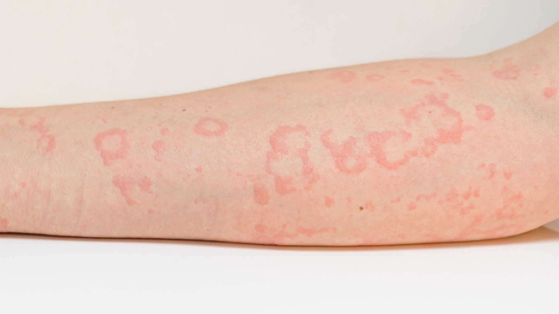 Chronic Hives - Causes, Symptoms, and Treatment