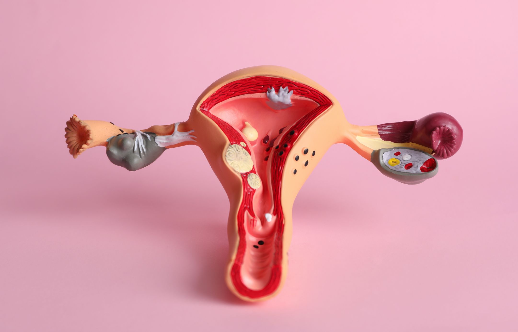 What causes endometrial cancer?