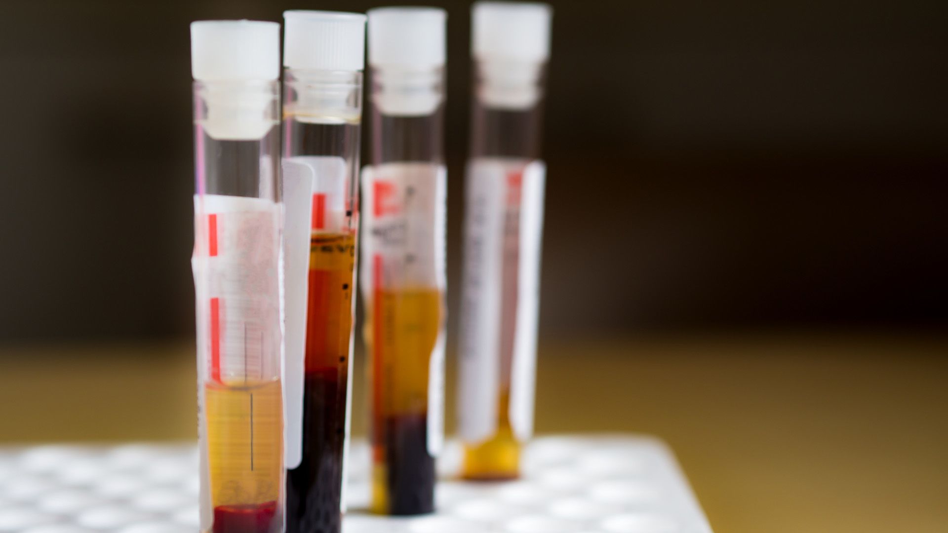 5 essential facts about immune thrombocytopenia (ITP)