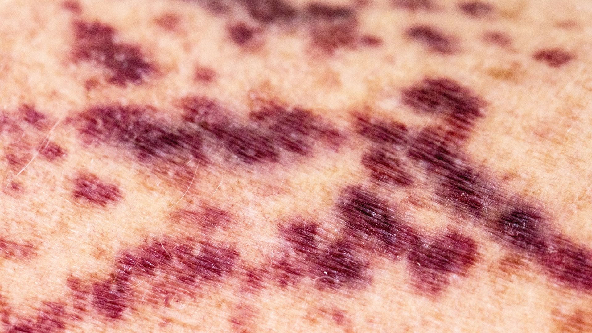 Why ITP causes bleeding and bruising symptoms