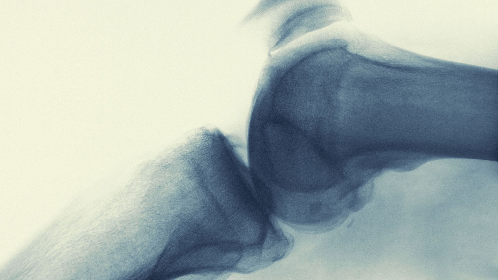 What are tenosynovial giant cell tumors?