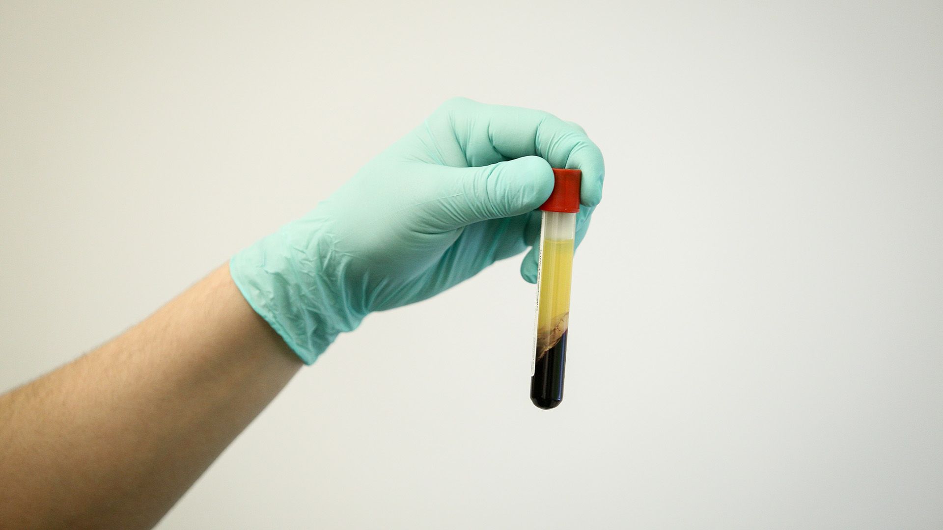 Treatment options for immune thrombocytopenia (ITP)