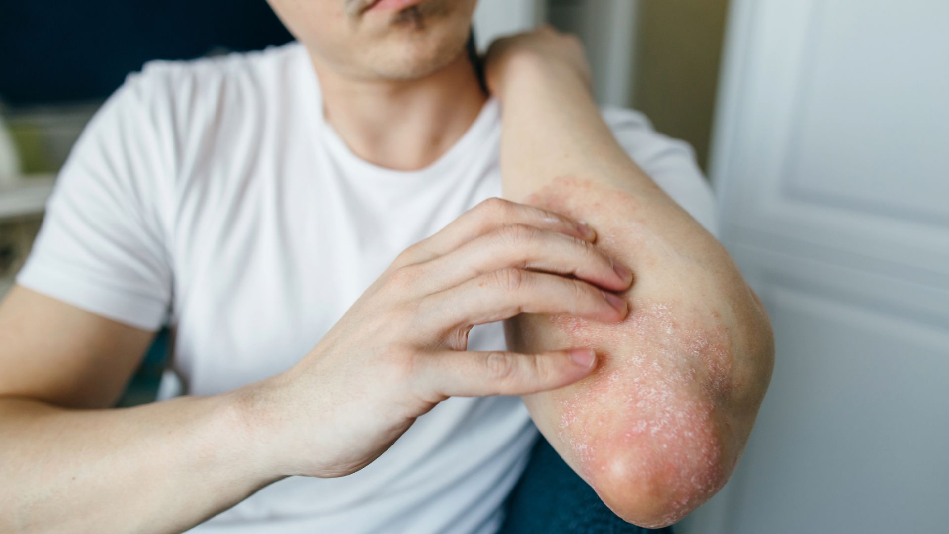 6 psoriasis topics to discuss with your healthcare provider