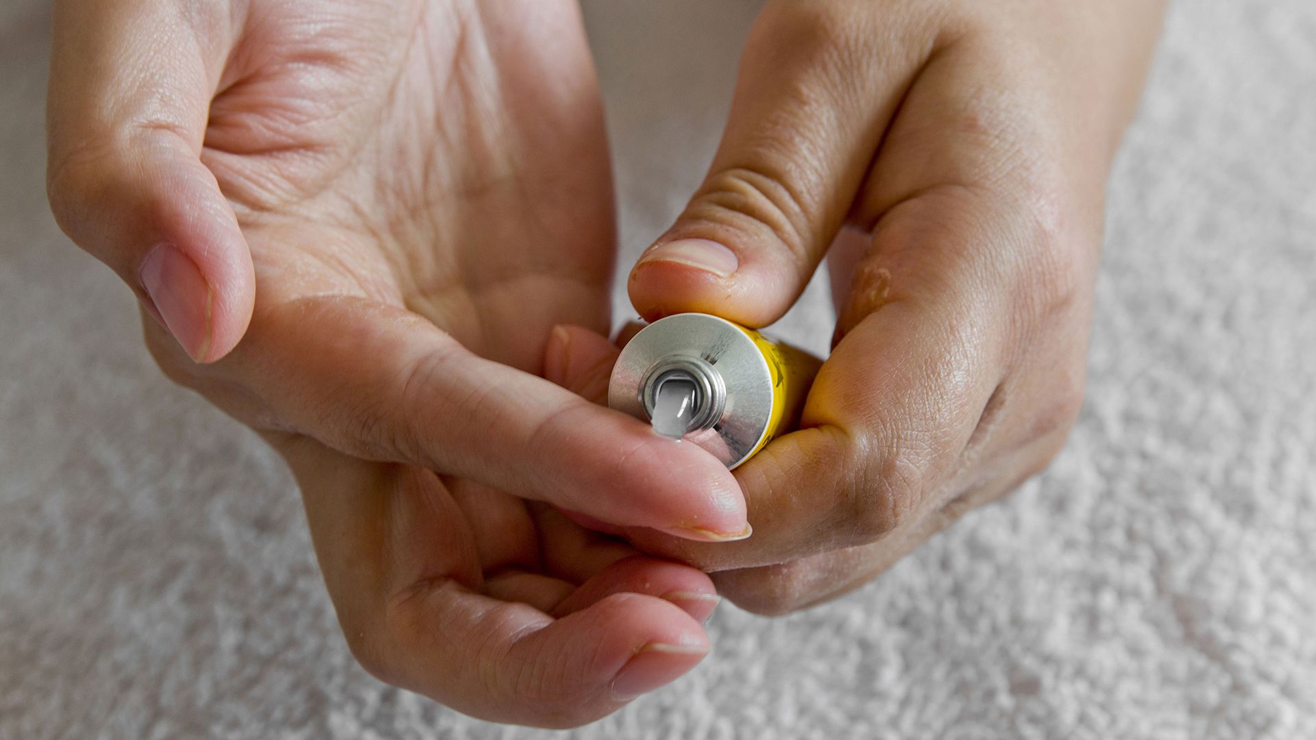 Treatment options for genital psoriasis