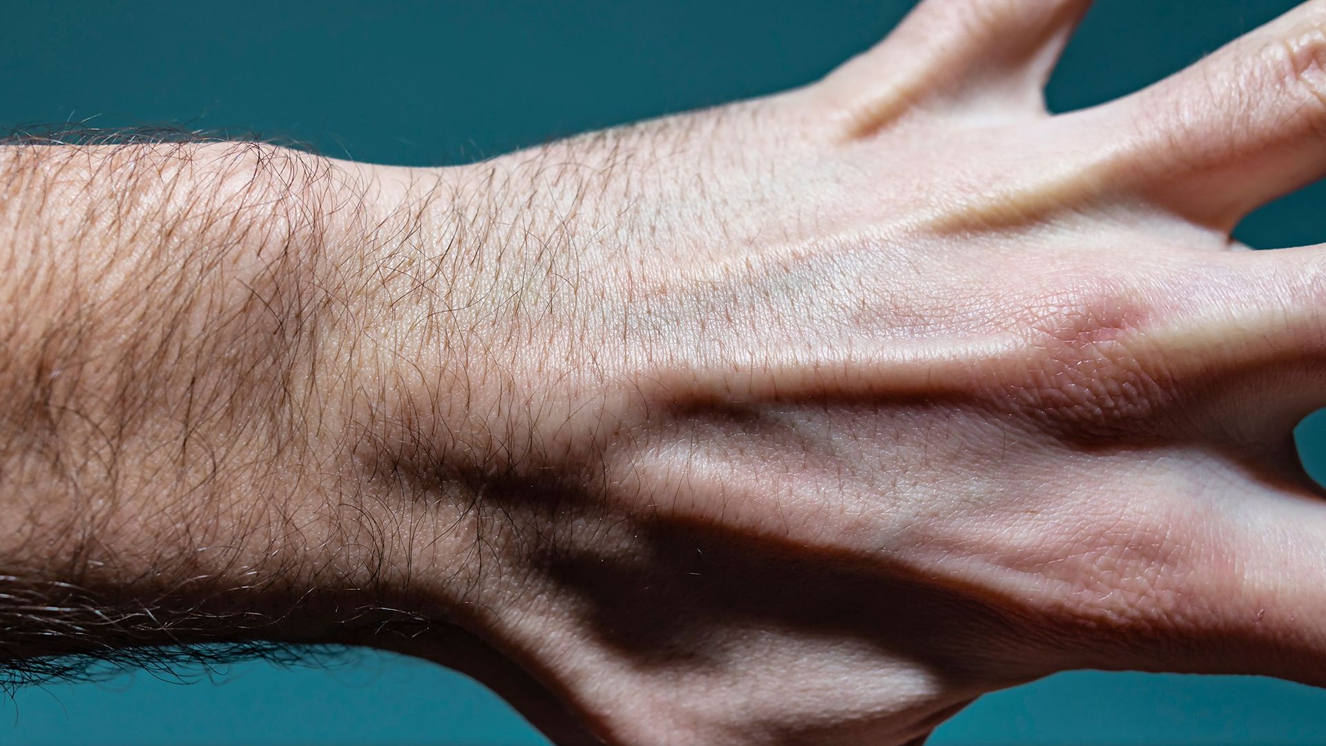 Common types of benign hand tumors