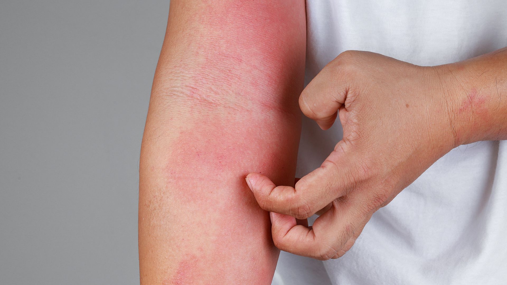 How to think about your atopic dermatitis treatment goals