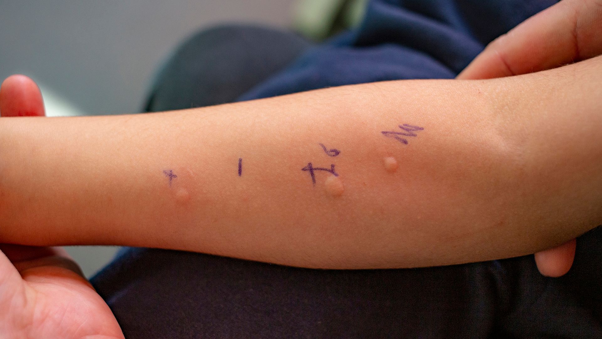 The difference between food allergy and food intolerance