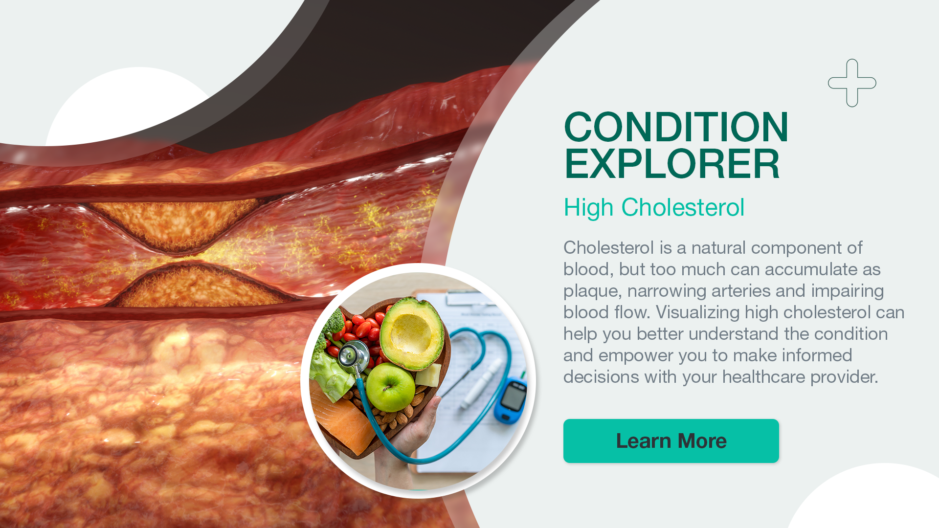 Condition Explorer: High Cholesterol