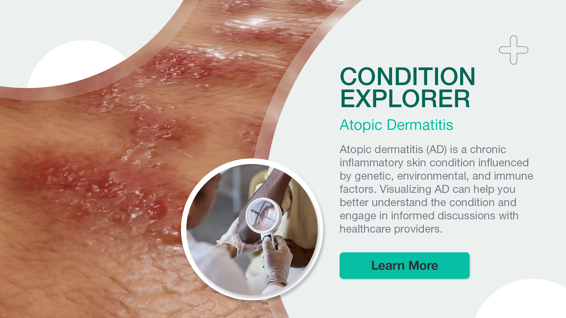 Condition Explorer: Atopic Dermatitis