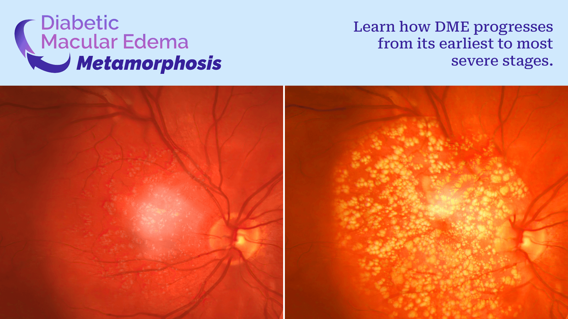 Condition Metamorphosis: DME