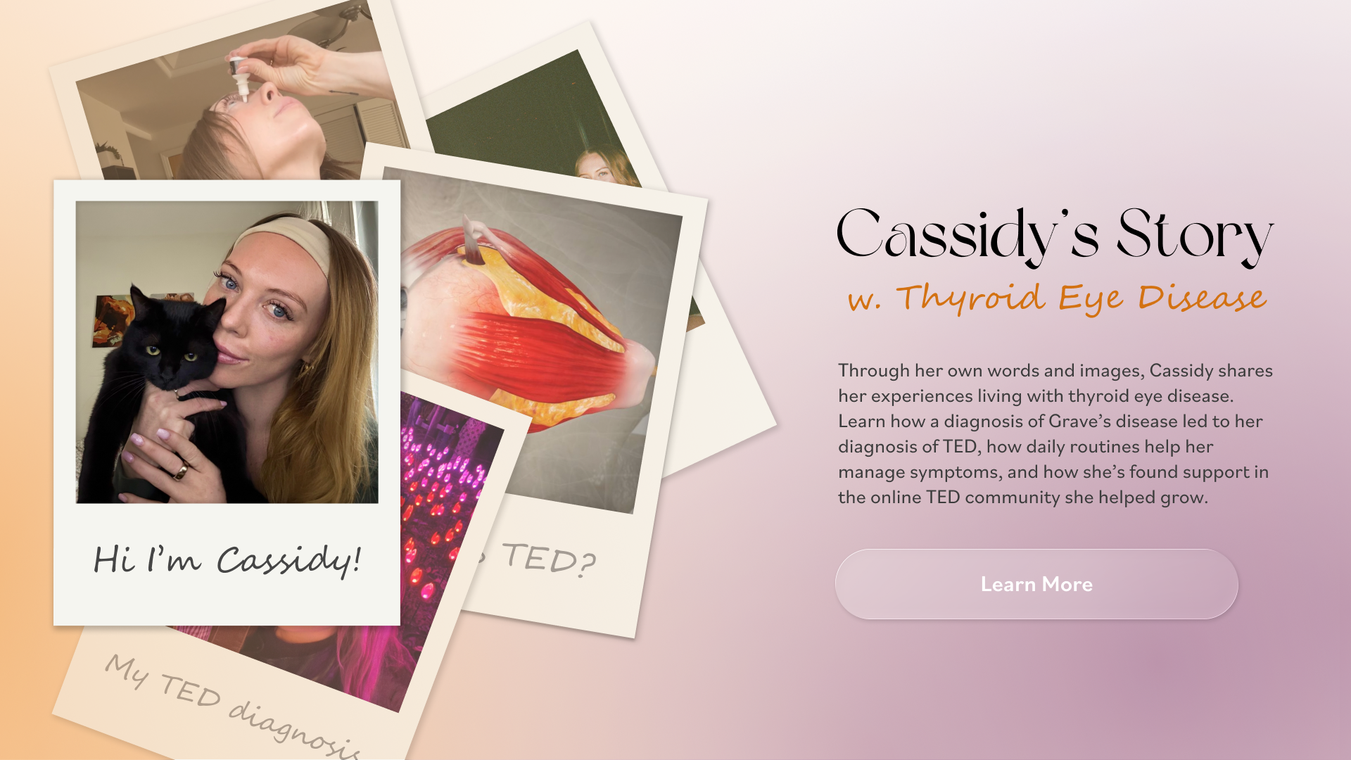 Interactive Patient Journey - Thyroid Eye Disease