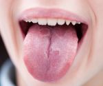 What Your Tongue Reveals About Your Health