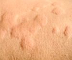 What’s on my skin? 8 common bumps, lumps, and growths
