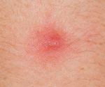 What’s on my skin? 8 common bumps, lumps, and growths