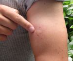 Ouch, what bit me? 10 common bug bites