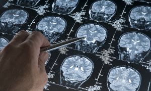 As Concussions Rise, Is MRI Enough?