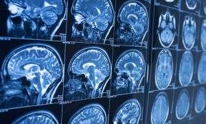 Learn the basics of Alzheimer's disease