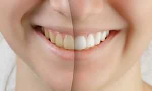 Teeth whitening tips and secrets