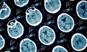 Do brain injuries lead to dementia?
