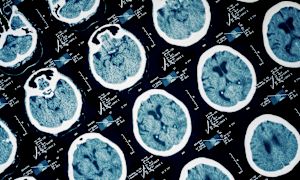Do brain injuries lead to dementia?