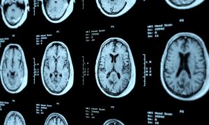 CTE causes, risk factors, and prevention