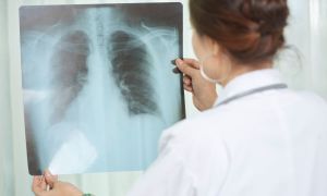 What you need to know about TB