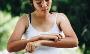 7 psoriasis triggers to avoid—and what to do instead
