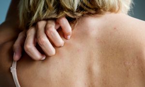 Is It Shingles, Psoriasis, Eczema or Something Else?