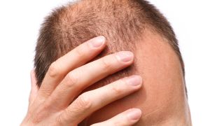 Is testosterone making you go bald?