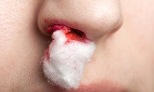 What you need to know about nosebleeds