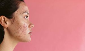 Understanding types of acne and acne severity