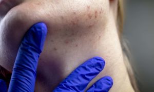 Understanding hormonal acne