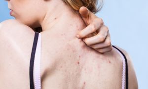 Hidradenitis suppurativa: symptoms, severity, and stages