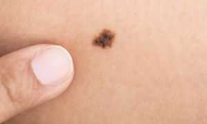 Are You Checking Your Skin for Cancer?