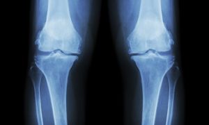 Is this common knee surgery effective?