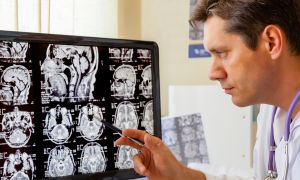 5 epilepsy treatment options