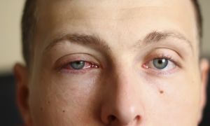 Pink eye: understanding causes, symptoms, and treatment