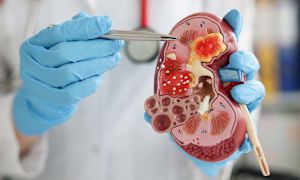 A quick guide to immunoglobulin A nephropathy (IgAN)