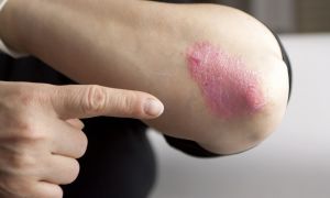5 different ways to think about psoriasis