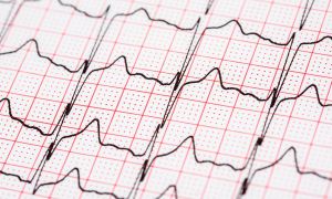 What you need to know about atrial fibrillation