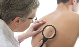Melanoma diagnosis more deadly for men than women