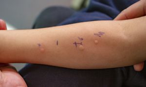 The difference between food allergy and food intolerance