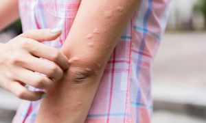 Is chronic spontaneous urticaria an autoimmune disease?