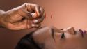 What You Need to Know About Acupuncture